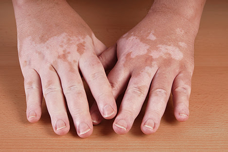Vitiligo No Início Da Infância Pode Ser Mais Agressivo